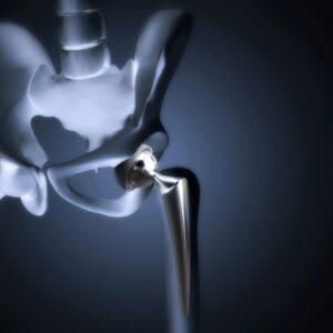 Gamma Sterilization of Orthopedic Implants: Reliable Sterility Without Compromising Material Performance